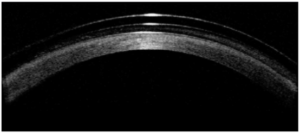 Foto adaptación lente córnea