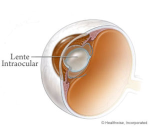 Intervención en la que se extrae el cristalino y se sustituye por una lente intraocular.