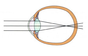 Ojo con Miopía Magna, caracterizado por un excesivo alargamiento del globo ocular