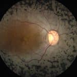 Comunicado: La fotobiomodulación no está probada para su tratamiento en la retinosis pigmentaria.