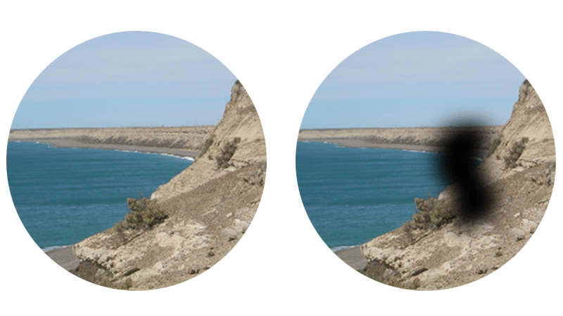 maculopatia d maculopatia d